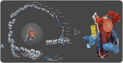 Procés de reconstrucció d’un model 3D, mitjançant fotogrametria, d’una escàpula humana on es mostra la cavitat glenoide amb presència del rodet glenoidal.