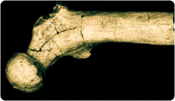 The femur of Orrorin tugenensis, a new step towards the origins of bipedalism